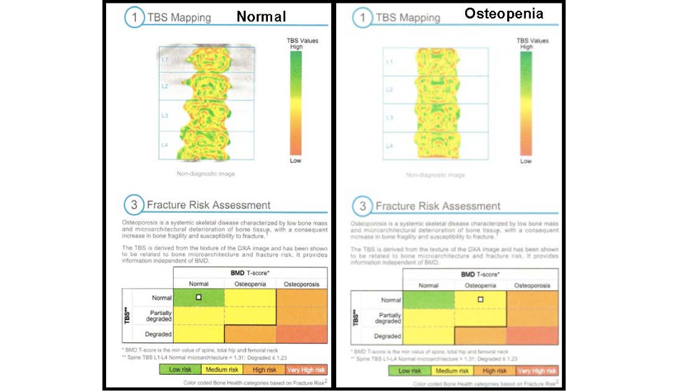 Bone health monitoring in athletes